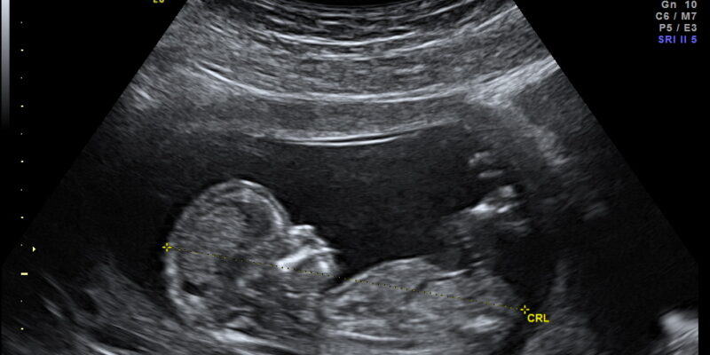 Florida Bill Allowing Fetal Wrongful Death Suits Narrowly Advances Amid Bipartisan Backlash
